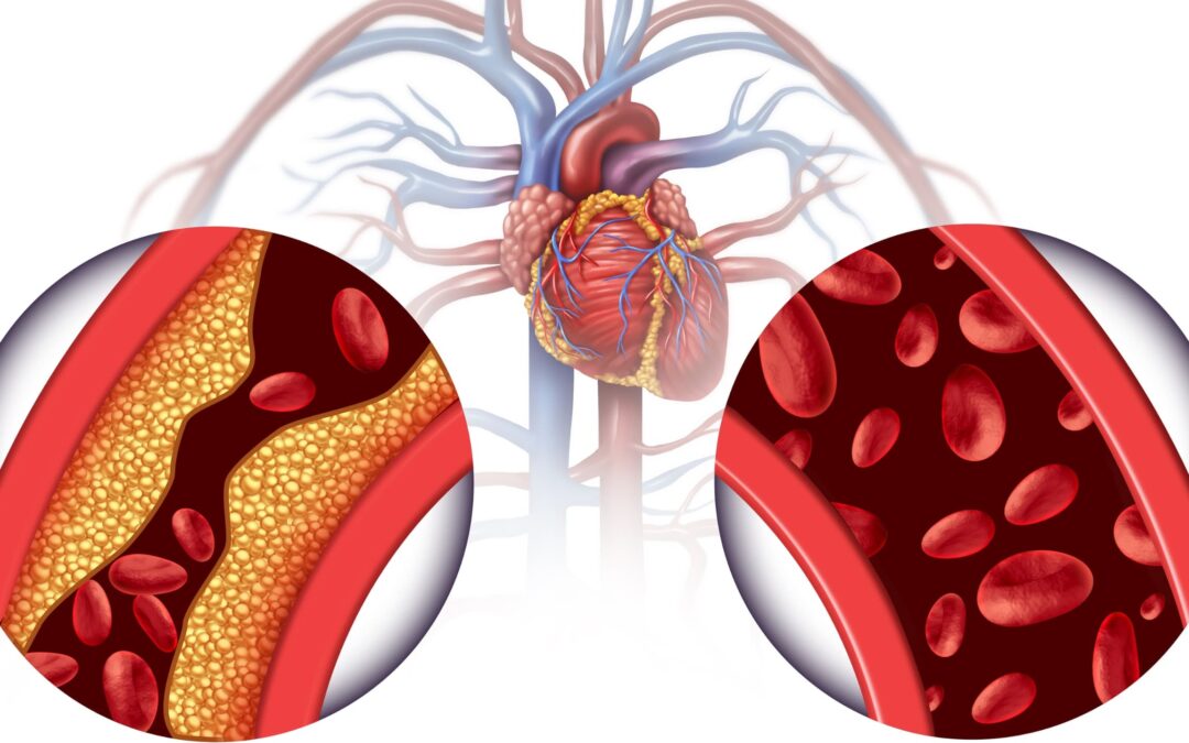 EDTA Chelation Therapy